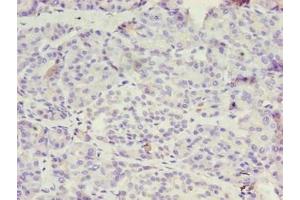 Immunohistochemistry of paraffin-embedded human ovarian cancer using ABIN7142122 at dilution of 1:100 (DPH1 antibody  (AA 192-318))