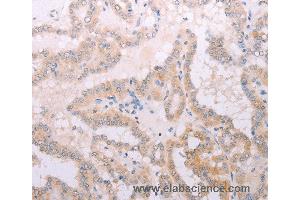 Immunohistochemistry of Human thyroid cancer using TPO Polyclonal Antibody at dilution of 1:50