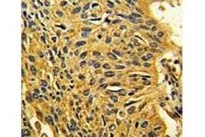 IHC analysis of FFPE human lung carcinoma stained with CDK2 antibody (CDK2 antibody  (AA 230-260))
