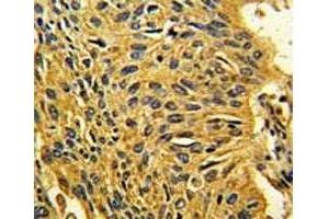 IHC analysis of FFPE human lung carcinoma stained with CDK2 antibody