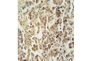 Immunohistochemistry analysis in formalin fixed and paraffin embedded human testis carcinoma reacted with LUZP4 Antibody (N-term) followed which was peroxidase conjugated to the secondary antibody and followed by DAB staining. (LUZP4 antibody  (N-Term))