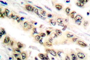 Immunohistochemical analysis of E2F4/E2F5 polyclonal antibody  in paraffin-embedded human lung carcinoma tissue.