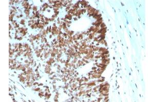 Formalin-fixed, paraffin-embedded human Colon Carcinoma stained with MSH6 Mouse Monoclonal Antibody (MSH6/2927). (MSH6 antibody  (AA 374-540))