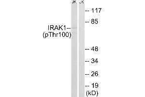 Immunohistochemistry analysis of paraffin-embedded human colon carcinoma tissue using IRAK1 (Phospho-Thr100) antibody. (IRAK1 antibody  (pThr100))