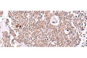 Immunohistochemistry of paraffin-embedded Human lung cancer tissue using IRX4 Polyclonal Antibody at dilution of 1:40(x200) (IRX4 antibody)