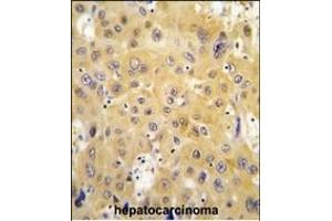 Formalin-fixed and paraffin-embedded human hepatocarcinoma tissue reacted with ECGF1 antibody (Center) (ABIN391460 and ABIN2841435) , which was peroxidase-conjugated to the secondary antibody, followed by DAB staining. (Thymidine Phosphorylase antibody  (AA 318-345))