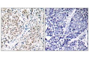 Immunohistochemical analysis of paraffin- embedded human breast carcinoma tissue using Myc (Ab-358) antibody (E021035). (c-MYC antibody)