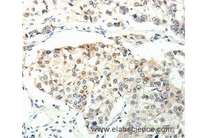 Immunohistochemistry of Human breast cancer using TPM2 Polyclonal Antibody at dilution of 1:60