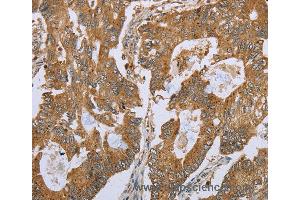 Immunohistochemistry of Human gastric cancer using NLRP10 Polyclonal Antibody at dilution of 1:45 (NLRP10 antibody)