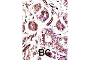 Formalin-fixed and paraffin-embedded human cancer tissue reacted with UBE3A polyclonal antibody  , which was peroxidase-conjugated to the secondary antibody, followed by DAB staining . (ube3a antibody  (C-Term))