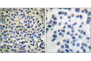 Immunohistochemistry analysis of paraffin-embedded human breast carcinoma tissue, using LIMK1/2 (Ab-508/505) Antibody. (LIMK-1/2 (AA 481-530) antibody)