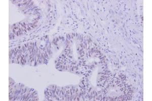 IHC-P Image ZNF45 antibody [N2C3] detects ZNF45 protein at nucleus on human colon carcinoma by immunohistochemical analysis. (ZNF45 antibody)