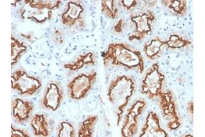 Formalin-fixed, paraffin-embedded human Renal Cell Carcinoma stained with RCC Rabbit Recombinant Monoclonal Antibody (CA9/2993R). (Recombinant CA9 antibody)