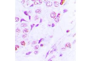 Immunohistochemical analysis of GCN5 staining in human lung cancer formalin fixed paraffin embedded tissue section. (KAT2A antibody  (C-Term))