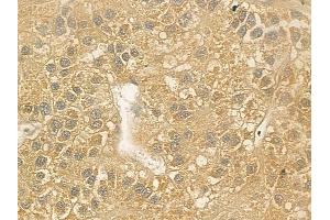ABIN6262563 and ABIN6276905 at 1/100 staining human hepatocellular carcinoma by IHC-P.