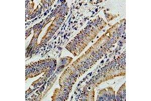 Immunohistochemical analysis of PIBF staining in human colon cancer formalin fixed paraffin embedded tissue section. (PIBF1 antibody)