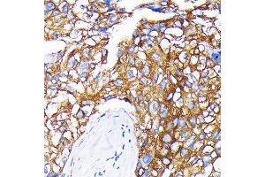 Immunohistochemistry of paraffin-embedded human liver cancer using Leptin Receptor Rabbit mAb (ABIN7268210) at dilution of 1:100 (40x lens). (Leptin Receptor antibody)