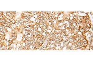 Immunohistochemistry of paraffin-embedded Human gastric cancer tissue using NR0B2 Polyclonal Antibody at dilution of 1:35(x200) (NR0B2 antibody)