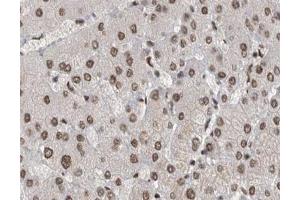 ABIN6267529 at 1/200 staining human liver cancer tissue sections by IHC-P. (SAPK, JNK (pTyr185) antibody)