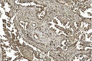 Immunohistochemical analysis of paraffin-embedded Human Lung adenocarcinoma section using Pink1 am1200a. (SUMO1 antibody)
