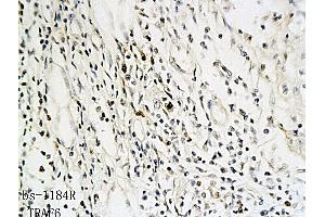 Formalin-fixed and paraffin embedded human oral squamous cell carcinoma labeled with Anti-TRAF6 Polyclonal Antibody, Unconjugated (ABIN738906) followed by conjugation to the secondary antibody and DAB staining (TRAF6 antibody  (AA 441-530))