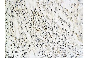 Formalin-fixed and paraffin embedded human oral squamous cell carcinoma labeled with Anti-TRAF6 Polyclonal Antibody, Unconjugated (ABIN738906) followed by conjugation to the secondary antibody and DAB staining (TRAF6 antibody  (AA 441-530))