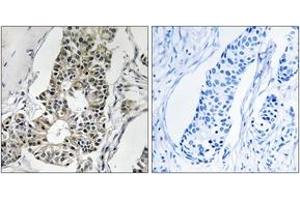 Immunohistochemistry analysis of paraffin-embedded human breast carcinoma tissue, using RIMS4 Antibody. (RIMS4 antibody  (AA 33-82))