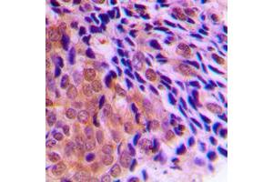 Immunohistochemical analysis of CLOCK staining in human prostate cancer formalin fixed paraffin embedded tissue section. (CLOCK antibody  (Center))