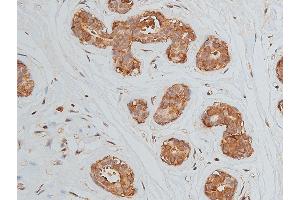 ABIN6269228 at 1/50 staining human breast cancer tissue by IHC-P. (VEGFR2/CD309 antibody)