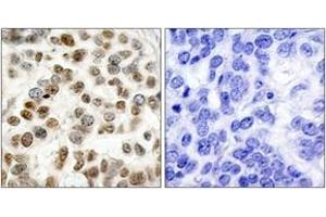 Immunohistochemistry analysis of paraffin-embedded human breast carcinoma tissue, using BRCA1 (Ab-1423) Antibody. (BRCA1 antibody  (AA 1391-1440))