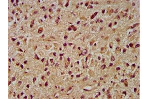 IHC image of ABIN7173964 diluted at 1:400 and staining in paraffin-embedded human glioma performed on a Leica BondTM system.