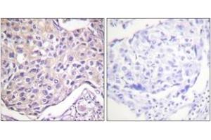 Immunohistochemistry analysis of paraffin-embedded human breast carcinoma, using GRK2 (Phospho-Ser29) Antibody. (GRK2 antibody  (pSer29))