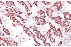 Immunohistochemistry of paraffin-embedded Human thyroid cancer using RPL24 Polyclonal Antibody at dilution of 1:100 (40x lens).