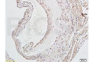 Formalin-fixed and paraffin embedded human endometrium carcinoma labeled with Rabbit Anti-NFKB p65 Polyclonal Antibody (ABIN668961), Unconjugated at 1:200 followed by conjugation to the secondary antibody and DAB staining.