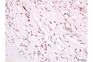 paraformaldehyde-fixed, paraffin embedded human breast carcinoma tissue, Antigen retrieval by boiling in sodium citrate buffer(pH6) for 15min, Block endogenous peroxidase by 3% hydrogen peroxide for 30 minutes, Blocking buffer (normal goat serum) at 37°C for 20min, Antibody incubation with Rabbit Anti-PDK1 (Ser241) Polyclonal Antibody, Unconjugated  at 1:500 overnight at 4°C, followed by a conjugated secondary and DAB staining (PDPK1 antibody  (pSer241))