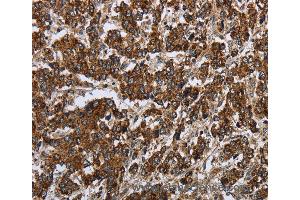 Immunohistochemistry of Human liver cancer using PPP1R13L Polyclonal Antibody at dilution of 1:30