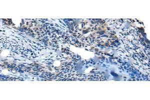 Immunohistochemistry of paraffin-embedded Human cervical cancer tissue using SAA4 Polyclonal Antibody at dilution of 1:35(x200) (SAA4 antibody)
