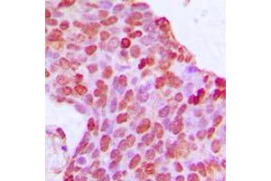 Immunohistochemical analysis of BCOR staining in human breast cancer formalin fixed paraffin embedded tissue section. (BCOR antibody  (Center))
