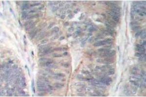 Immunohistochemistry (IHC) analyzes of p-PKR antibody in paraffin-embedded human colon carcinoma tissue. (EIF2AK2 antibody  (pThr451))
