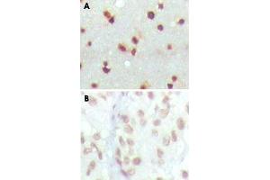 Immunohistochemical analysis of paraffin-embedded human cerebra (A) and lung carcinoma (B) tissue using MDM4 monoclonal antobody, clone 2D10F4 , showing nuclear localization with DAB staining.