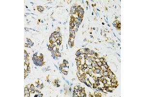 Immunohistochemistry of paraffin-embedded human esophageal cancer using ADSS antibody (ABIN6292806) at dilution of 1:100 (40x lens). (ADSS antibody)