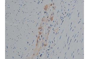 ABIN6256799 and ABIN6267420 at 1/50 staining human colon carcinoma tissue sections by IHC-P.