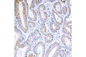 Immunohistochemical analysis of ARF4 staining in human colon cancer formalin fixed paraffin embedded tissue section. (ARF4 antibody  (Center))