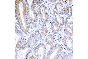 Immunohistochemical analysis of ARF4 staining in human colon cancer formalin fixed paraffin embedded tissue section. (ARF4 antibody  (Center))