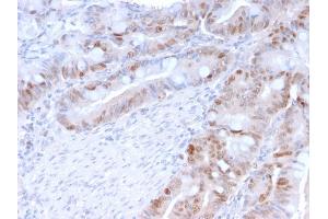Formalin-fixed, paraffin-embedded human Colon Carcinoma stained with PCNA Mouse Monoclonal Antibody (PC5). (PCNA antibody)