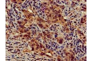Immunohistochemistry of paraffin-embedded human pancreatic cancer using ABIN7145339 at dilution of 1:100 (ATG14 antibody  (AA 1-492))