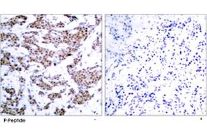 Immunohistochemical analysis of paraffin-embedded human breast carcinoma tissue using MEF2A (phospho T312) polyclonal antibody . (MEF2A antibody  (pThr312))