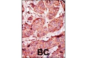 Formalin-fixed and paraffin-embedded human cancer tissue reacted with the primary antibody, which was peroxidase-conjugated to the secondary antibody, followed by AEC staining. (PFKP antibody  (C-Term))