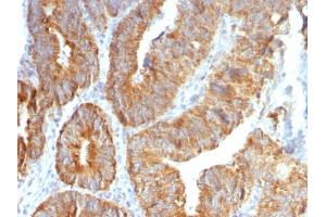 Formalin-fixed, paraffin-embedded human Colon Carcinoma stained with TNFS15 / VEGI Monoclonal Antibody (VEGI /1283). (TNFSF15 antibody)