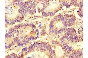 Immunohistochemistry of paraffin-embedded human colon cancer using ABIN7153920 at dilution of 1:100 (SLC37A1 antibody  (AA 245-302))